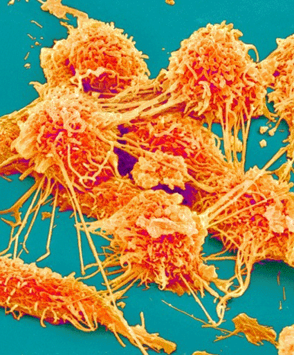 Image: Colored scanning electron micrograph (SEM) of cancer cells from the human colon (photo courtesy Susumu Nishinaga / SPL).
